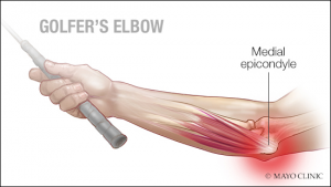 Golfer's Elbow treatment at PT2Go Physical Therapy in Virginia Beach, VA and Moyock NC