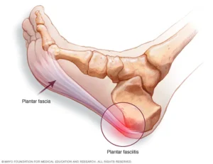 Plantar Fasciitis treatment at PT2Go Physical Therapy in Virginia Beach, VA and Moyock NC