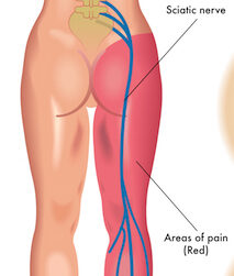 Sciatic Nerve treatment at PT2Go Physical Therapy in Virginia Beach, VA and Moyock NC