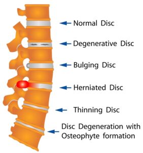 Herniated Disc Treatment at PT2Go Physical Therapy in Virginia Beach, VA and Moyock NC
