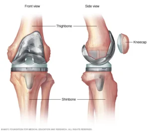 Total Knee Replacement rehab at PT2Go Physical Therapy in Virginia Beach, VA and Moyock NC