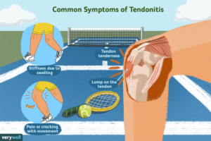 Symptoms of Tendonitis